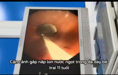Bệnh viện sản nhi Quảng Ngãi gắp dị vật